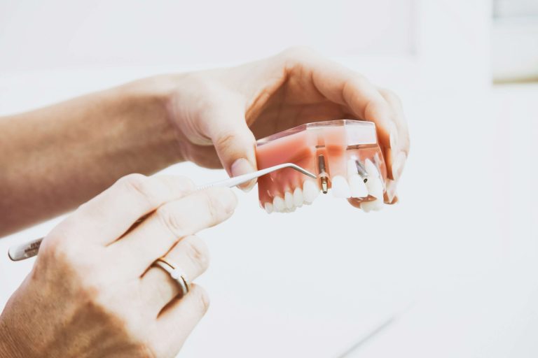 zubné implantáty v dentálnej klinike Bentclinic v Nitre